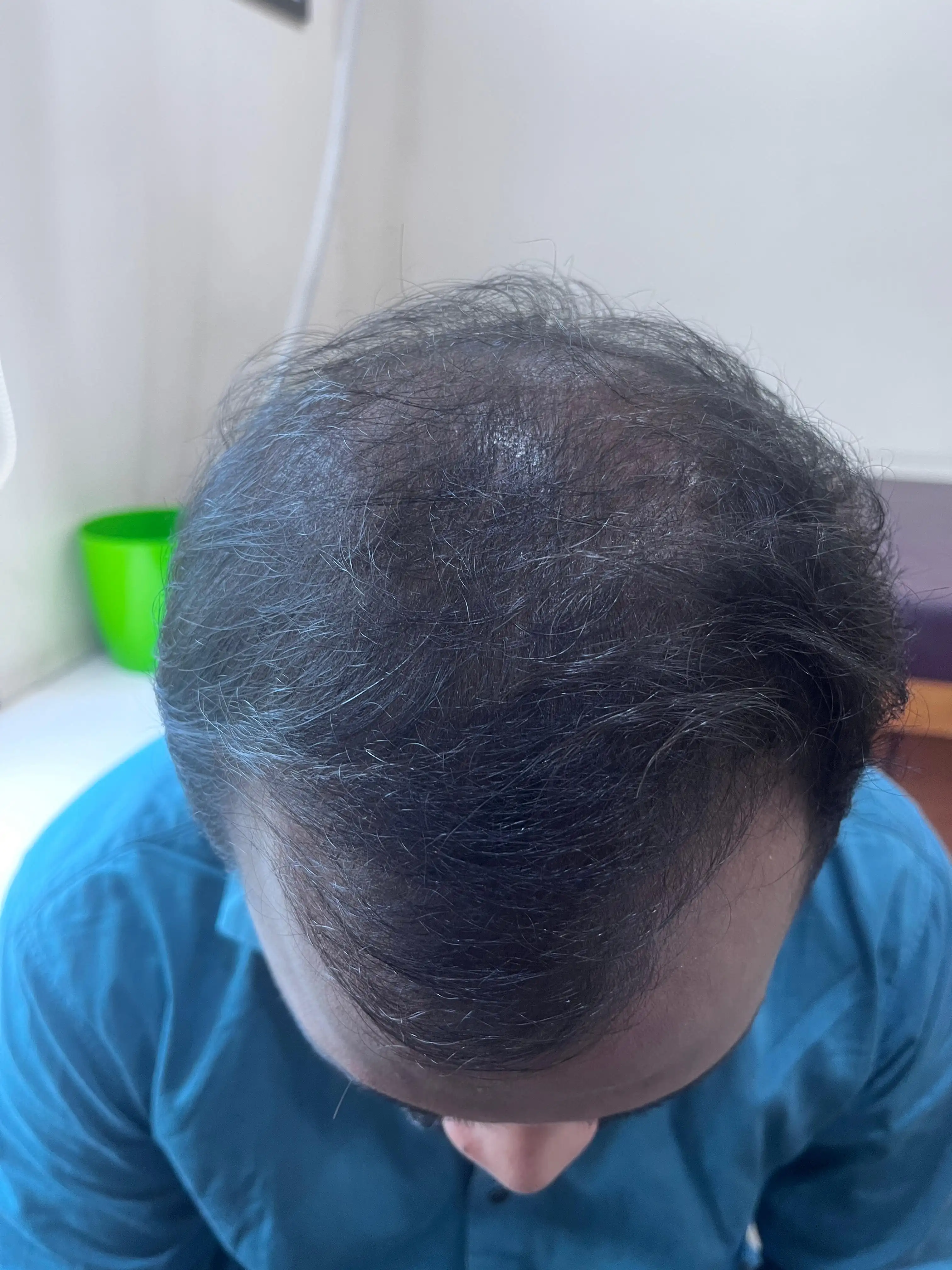 Male Pattern Baldness case 3 after treatment